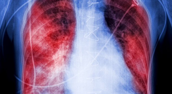 Study Aims to Evaluate Duvelisib in Reducing Lung
