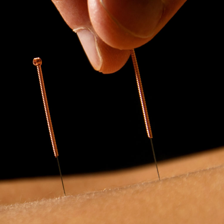 Study Examines Cost, Efficacy of Group Acupuncture for Patients With